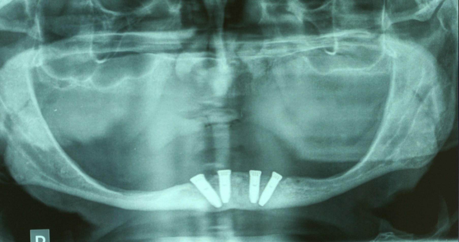 Fot.2: Założone 4 implanty w systemie All-on-4